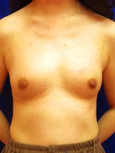 ①術後3ヶ月　正面